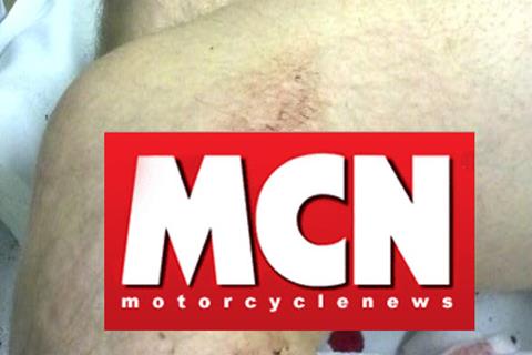 Easton’s Cadwell crash injury