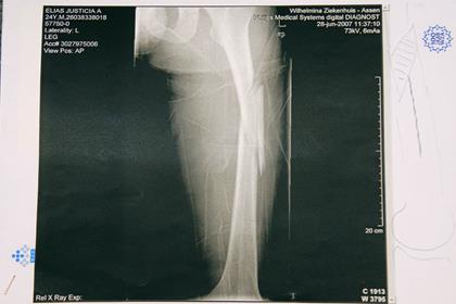 X-ray of Toni Elias' broken femur 