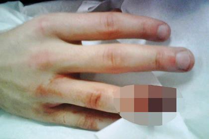 Jonathan Rea's injured finger, click on the link in the story to see it in full glory