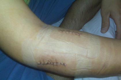 Michel Fabrizio has had surgery to hopefully cure arm pump he's been struggling with in races