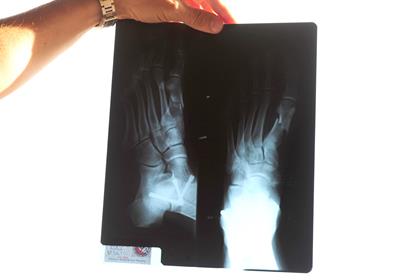 Biaggi shows off his X-ray taken today